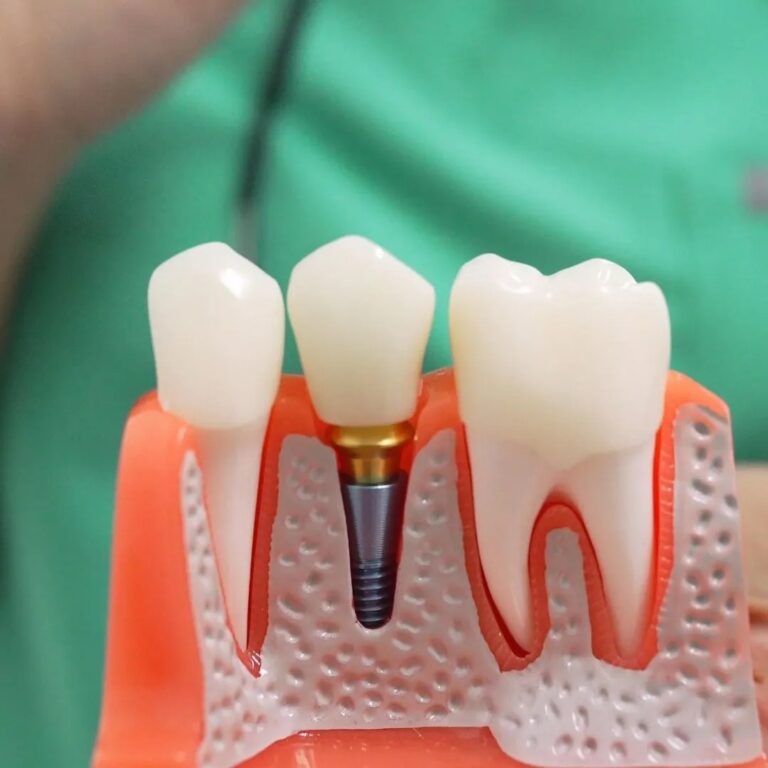 Dental implants in Vauxhall London: what to eat after surgery and how to manage recovery safely Dental implants in Vauxhall London
