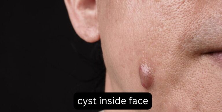 Cyst Inside Face